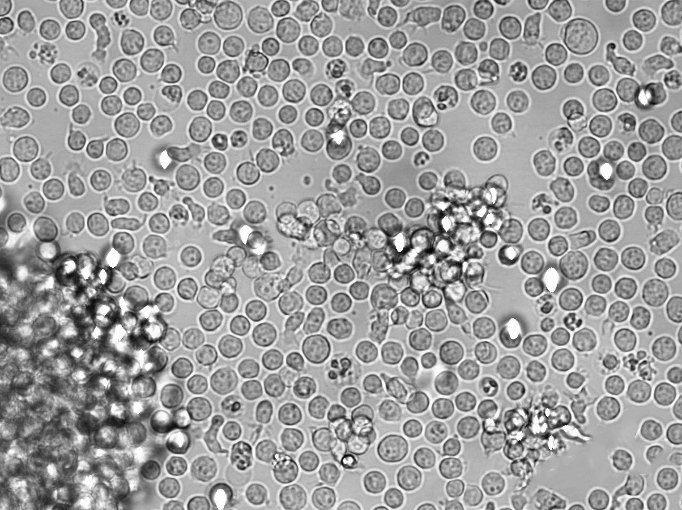 NK-92MI Cell|人恶性非霍奇金淋巴瘤患者NK细胞